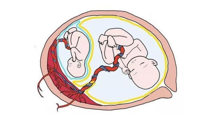 单绒毛膜双胞胎独有病发症