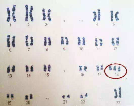 16号三体核型