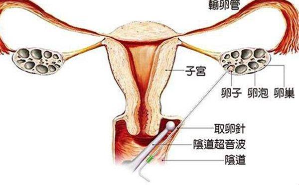 取卵手术（图）