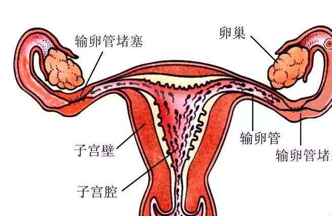 41岁输卵管堵塞可以直接做试管婴儿吗？