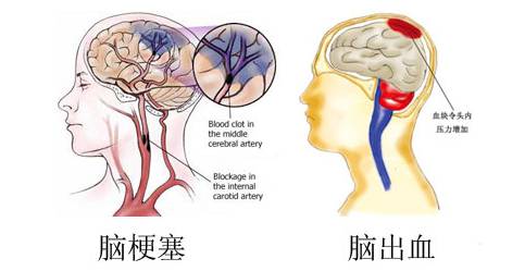 干细胞治疗糖尿病