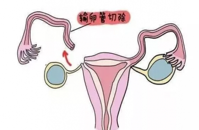 江西慈铭博鳌国际医院三代试管婴儿，切除双侧输卵管还能做试管婴儿吗？